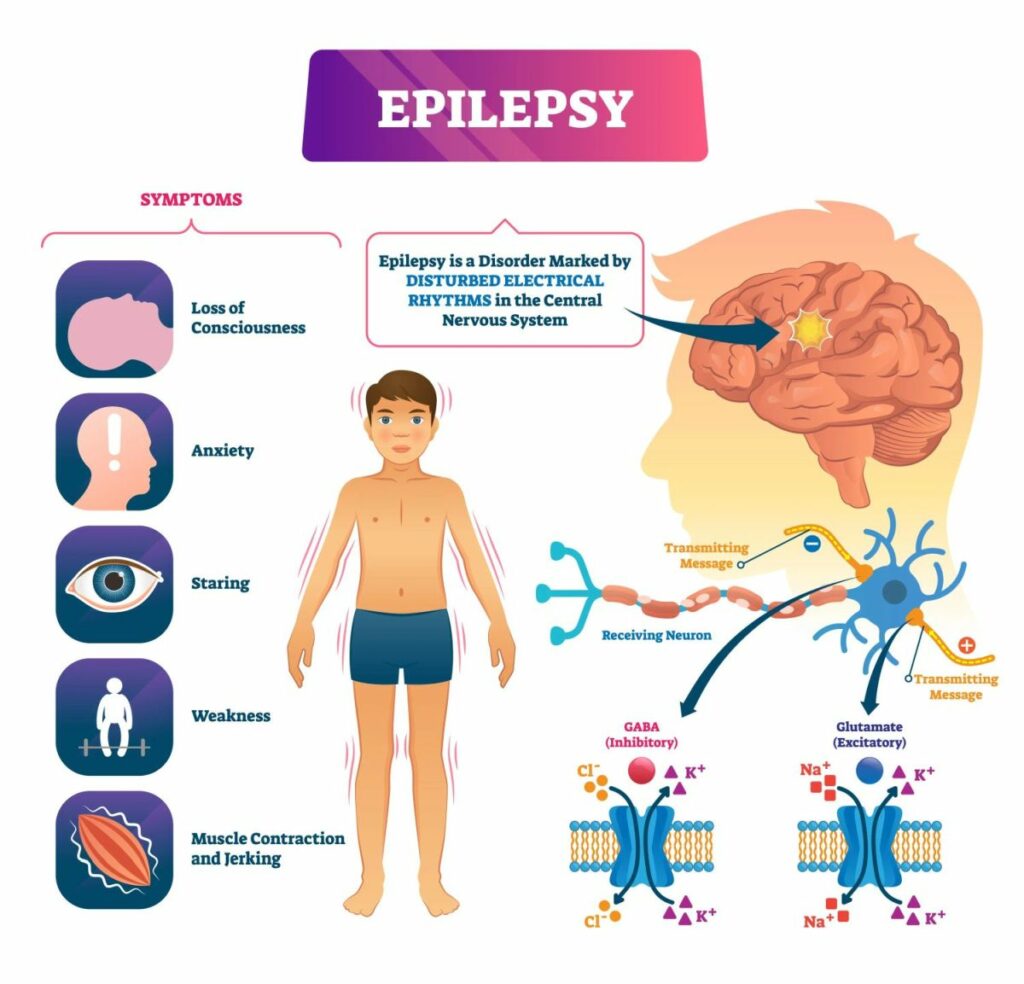 Treatment For Epilepsy